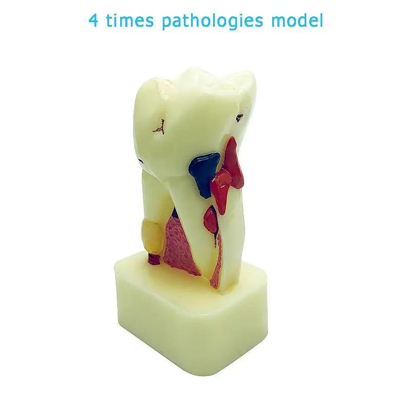 Стоматологическая модель 4-кратной патологии демонстрационная зубов