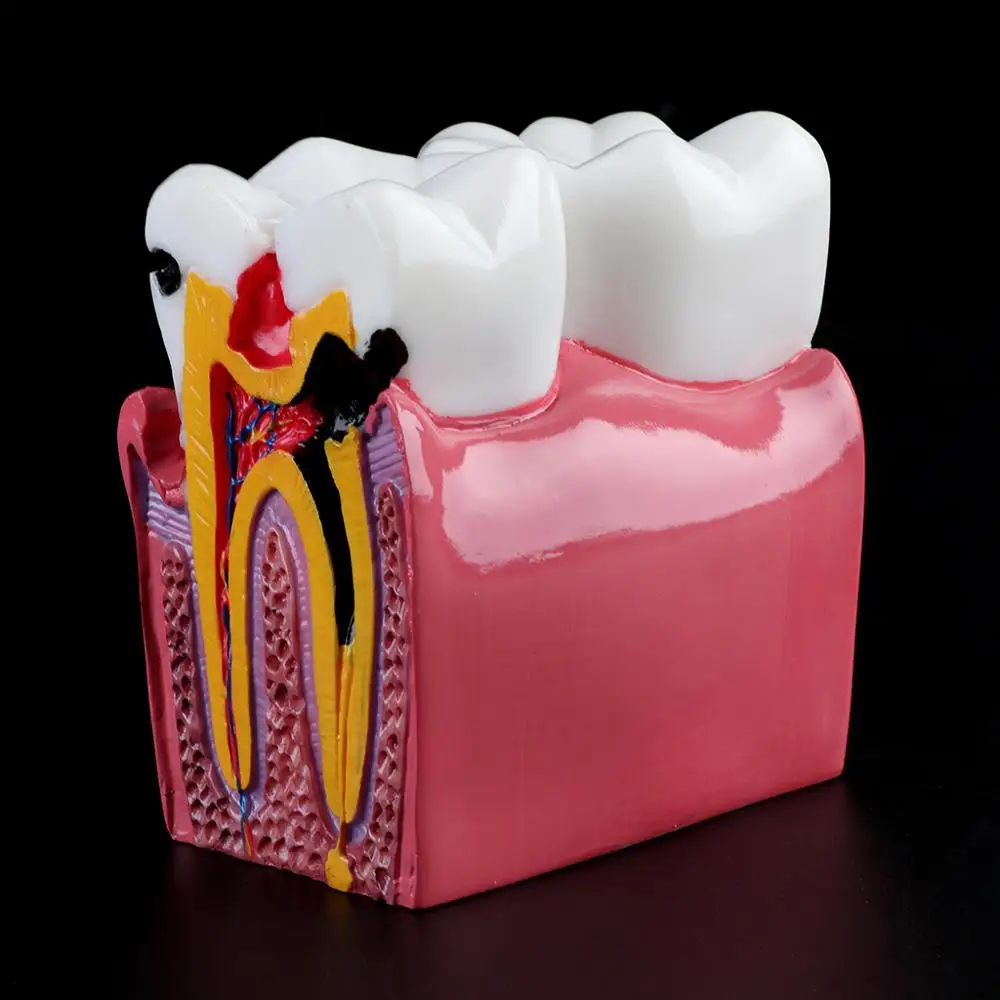 

6 Times Dental Caries Comparation Anatomy Teeth Model for Dental Anatomy Lab Teaching Studying Researching Tool