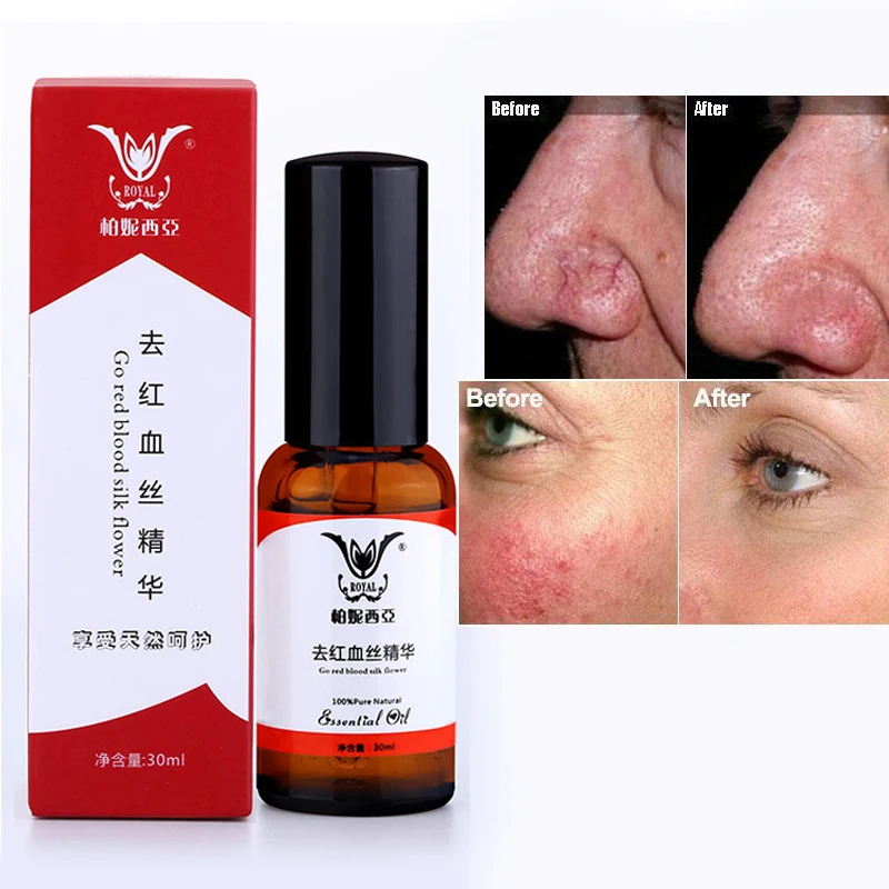 

Anti-Spider Vein Oil Face Redness Removal Red Blood Silk Repair Essential Oil Sensitive Skin Treatment Face primer drop shipping