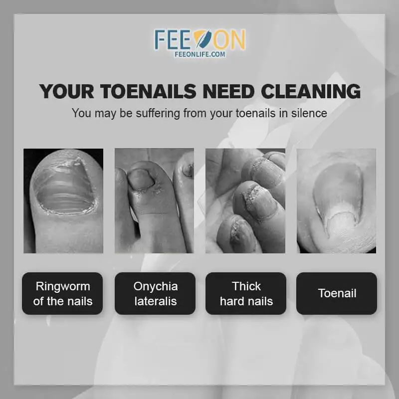 Toenail Clippers For Elderly, Used For Thick Toenails Fungi Toenails  Ingrown Toenails. Long Handle, Leather Packaging, Safe Storage
