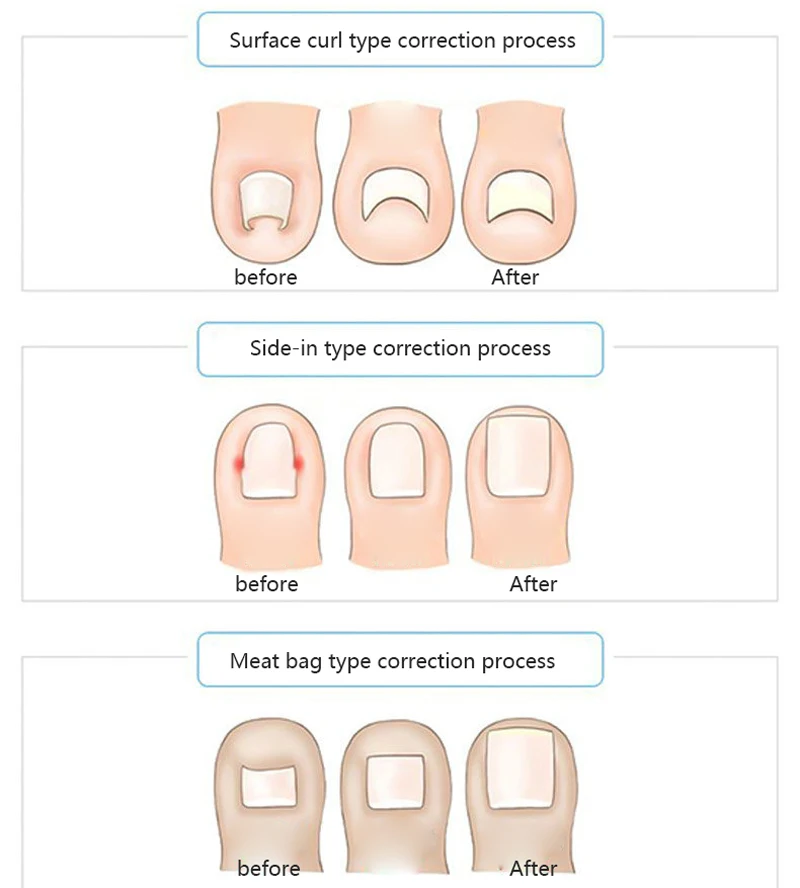 Коррекция педикюра для ногтей с открытым носком, инструменты для коррекции параониксии, наклейки-заплатки, уход за ногами, выпрямитель скрепок, Лечение ногтей