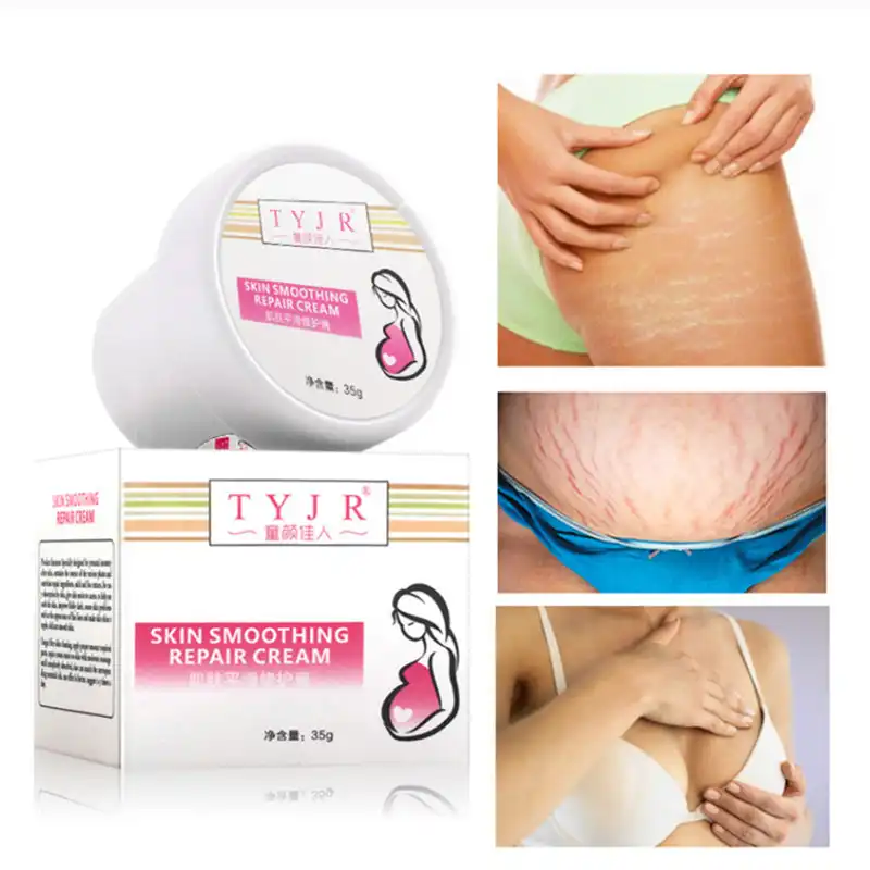 stretch marks on hips cream