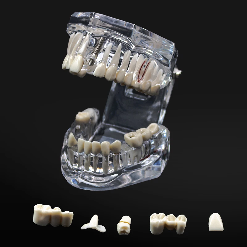 1 szt. Model dentystyczny Zęby Implant Przywrócenie mostu Badanie dydaktyczne Ząb Nauki medyczne Choroby dentysty Produkty stomatologiczne|Wybielanie zębów| - AliExpress