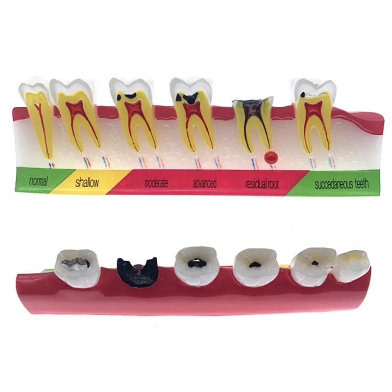 

Dental caries classify model Tooth Model of pathological process around teeth Dental teeth caries Evolution decayed Model