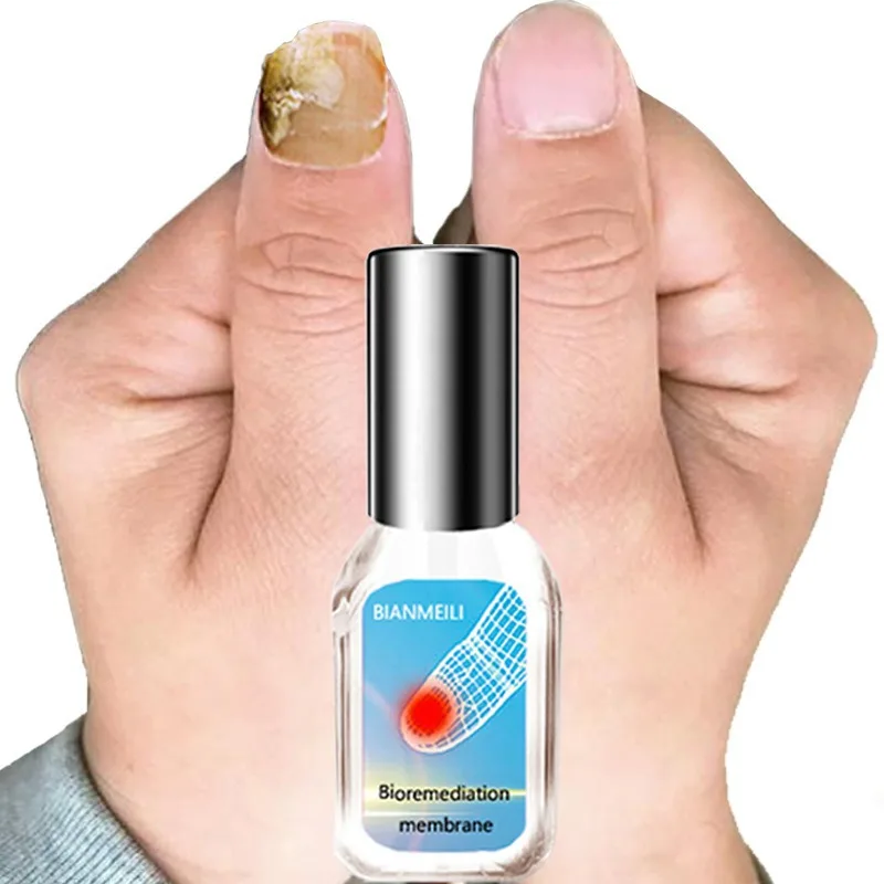 Ручка для лечения грибков ногтей Антибактериальная пленка антигрибковая инфекция ремонт раствор питательное масло для ремонта ногтей DC68