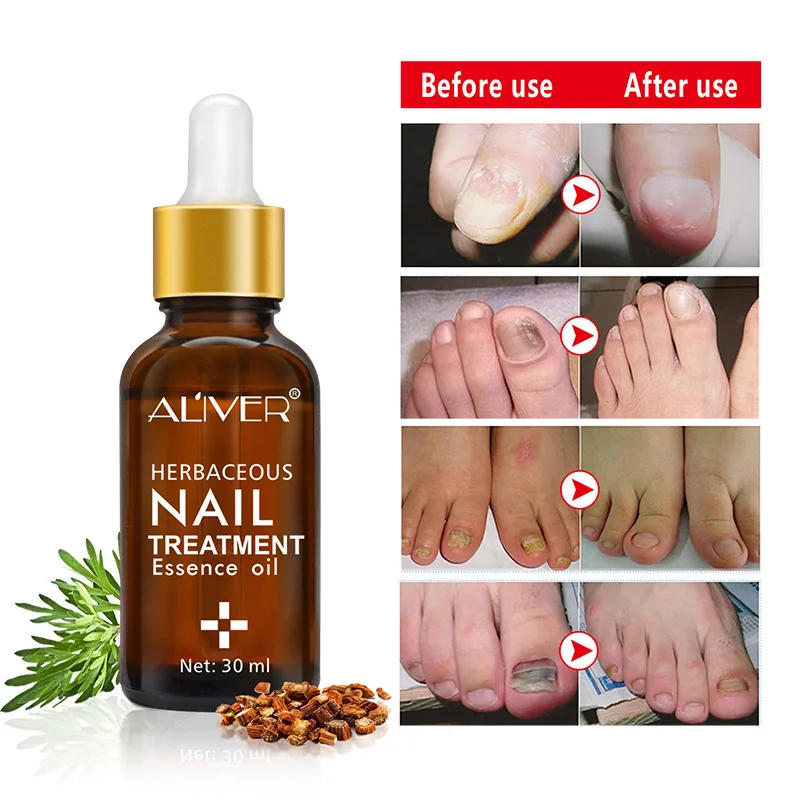 

30ml Professional Nail Treatment From Fungus Feet Hand Disinfection Nail Fungal Treatment Oil Pen Manicure Treatment Tools