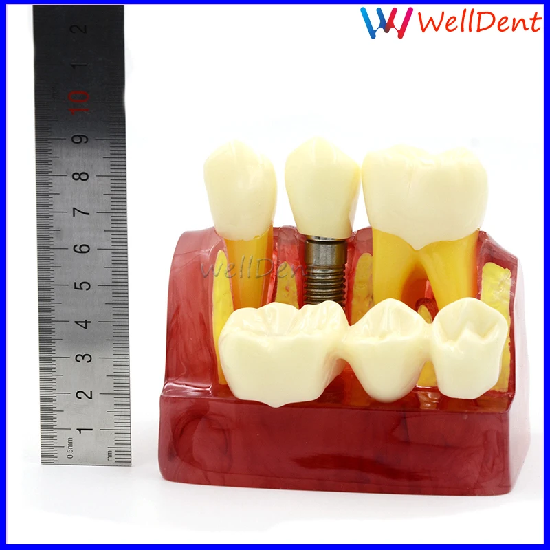 1-Macro-Implant-Model-Crown-Bridge-Demostratation-Teeth