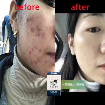 

Medical plaster Chinese medicines traditional chinese medicine acne whitening for woman skin face care beauty Massager for face