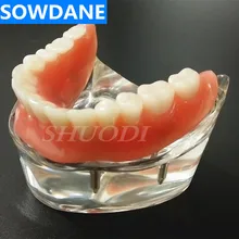 Стоматологическая Overdenture интерьер челюсти нижняя с 4 восстановления зубов обследование зубов Научите Модель