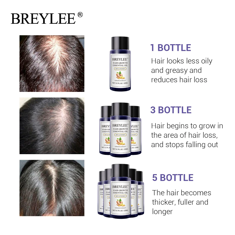 BREYLEE Hair Growth Essential Oil 20ml Fast Powerful Hair Products Hair Care Prevent Baldness Anti-Hair Loss Hair Serum Beauty  (3)