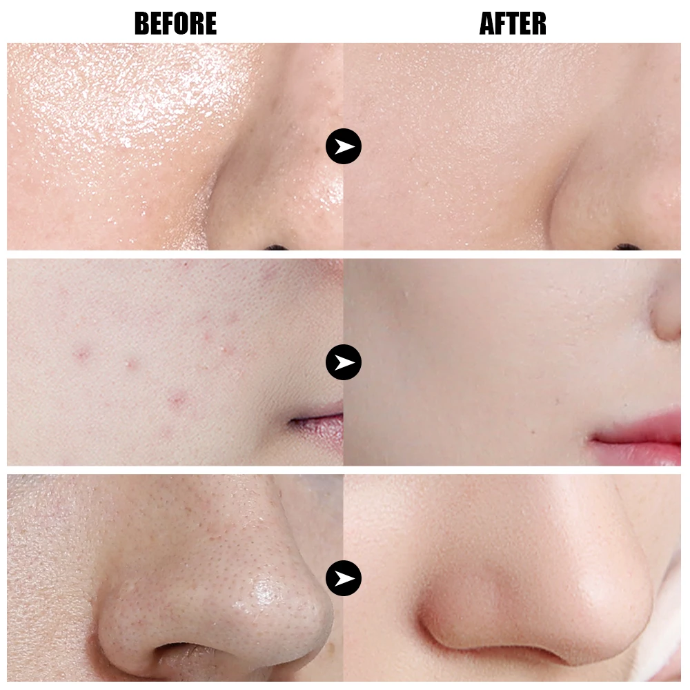 Face Mask Icy Mineral Mud Clay Oil Control Deep Cleansing Blackhead Remover Cleanser Shrinks Pores Nourishing Acne Treatment|Средства для