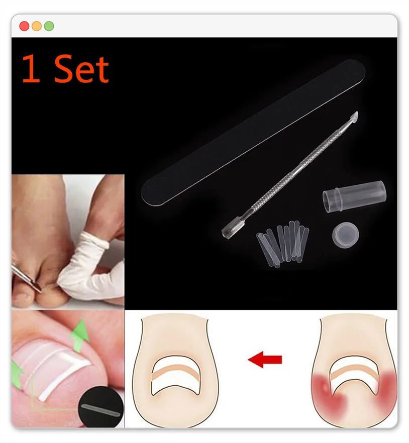 NEW 1 Set Toenail Straightening Clip Foot Care Curved Brace Toe Nail Ingrown Toenail Patch Pusher Recover Straightening Clip