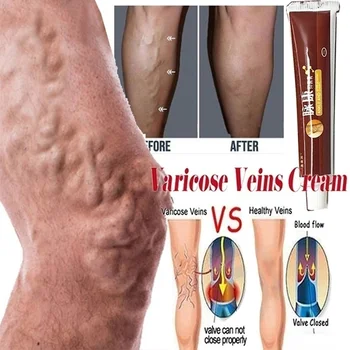 

Varicose Veins Treatment Cream Vasculitis Phlebitis Spider Leg Ointment Herb Medical Plaster Angiitis Removal Patch