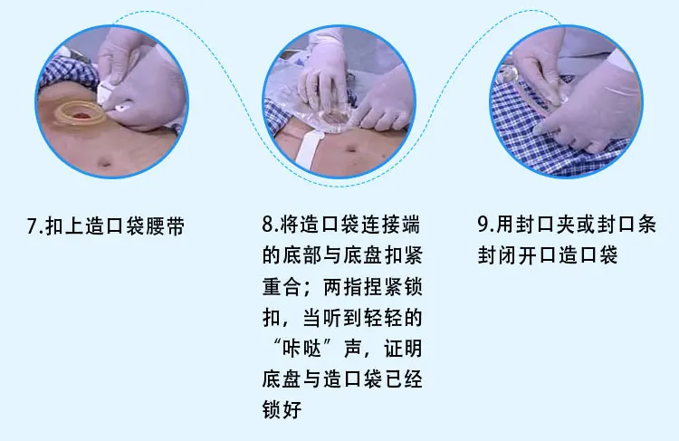 5 шт. stoma шасси прозрачное основание мокроты анус калоприемник одноразовые ostomy мешок база 10-55 мм