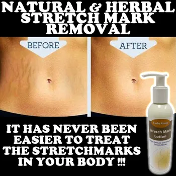 

FADE AWAY STRETCH MARK NATURAL LOTION CREAM HIGH STRENGTH REMOVES SCARS