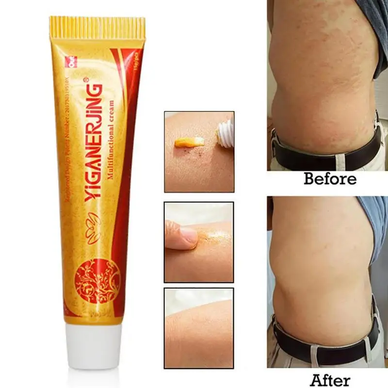 

YAGEN New Chinese Medicine Skin Cream Psoriasis Dermatitis Eczematoid Eczema Ointment Treatment Psoriasis Cream Skin Care Cream
