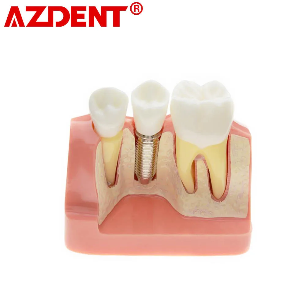 Dental Model Implant Analysis Crown Bridge Demonstration Teeth Model for Education with Removable Crowns ZYR-2017