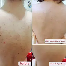 Хоббилайн серное мыло контроль масла лечение акне Очищение тела от акне, псориаза Себорея Ванна отбеливание шампунь Ремонт кожи