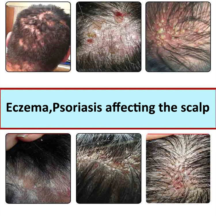 psoriasis cuir chevelu cause