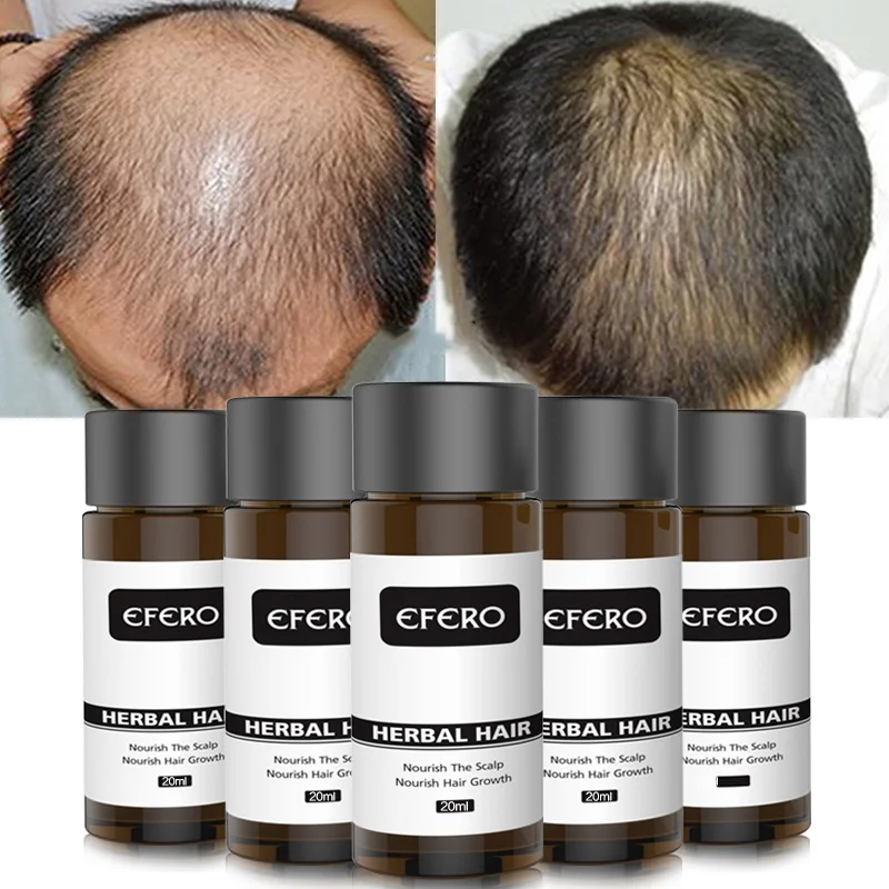 

Hair Growth Essential Powerful Growth Essence Oil Anti Loss Prevent Baldness Maintenance Hair Care Repair 20ml NEW