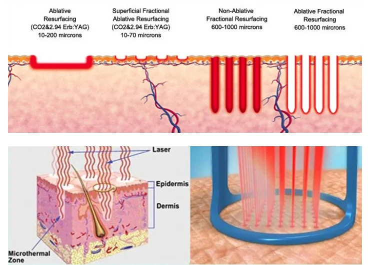 Профессиональный фракционный co2 лазер Yting RF CO2 лазерный фракционный прибор медицинский CE