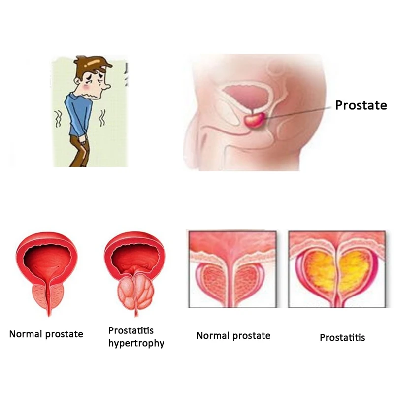 100 pcs ZB Prostatic navel plaster prostatitis urology patch urological plaster prostatitis Chinese herbal herbal patch