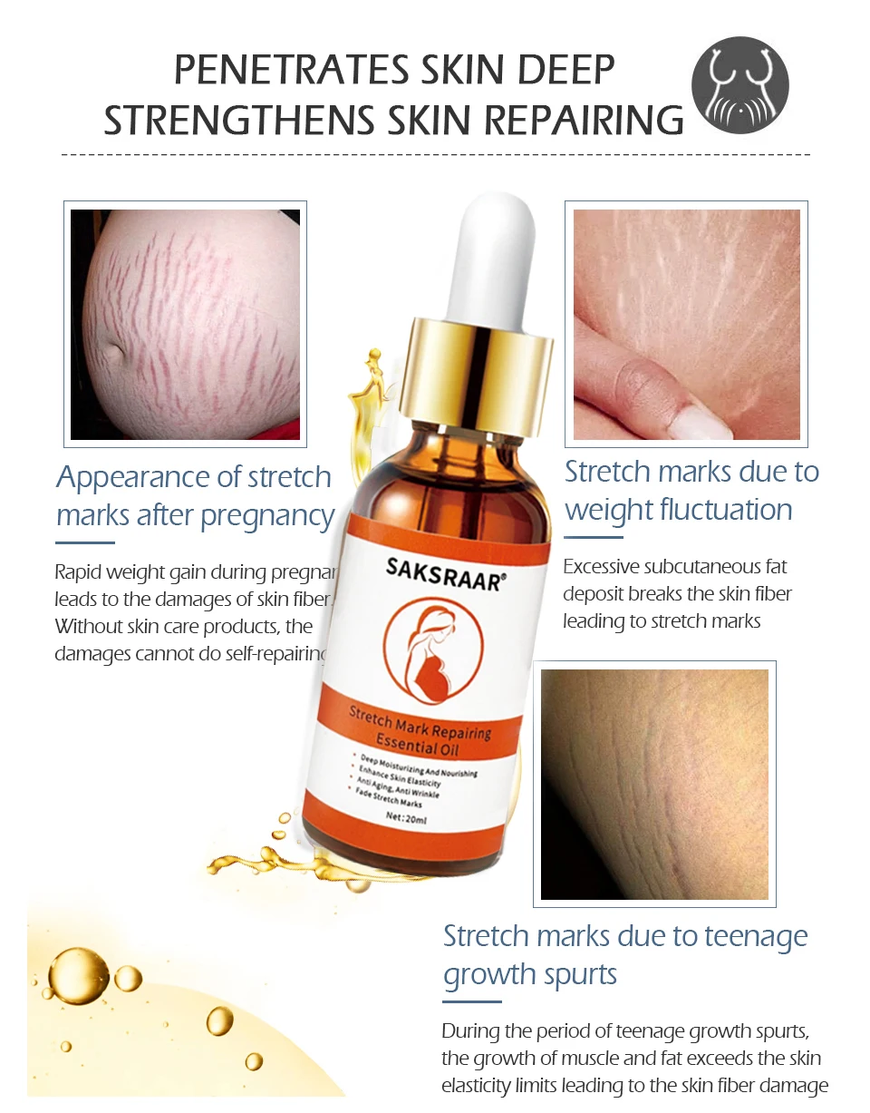 stretch marks removal oil