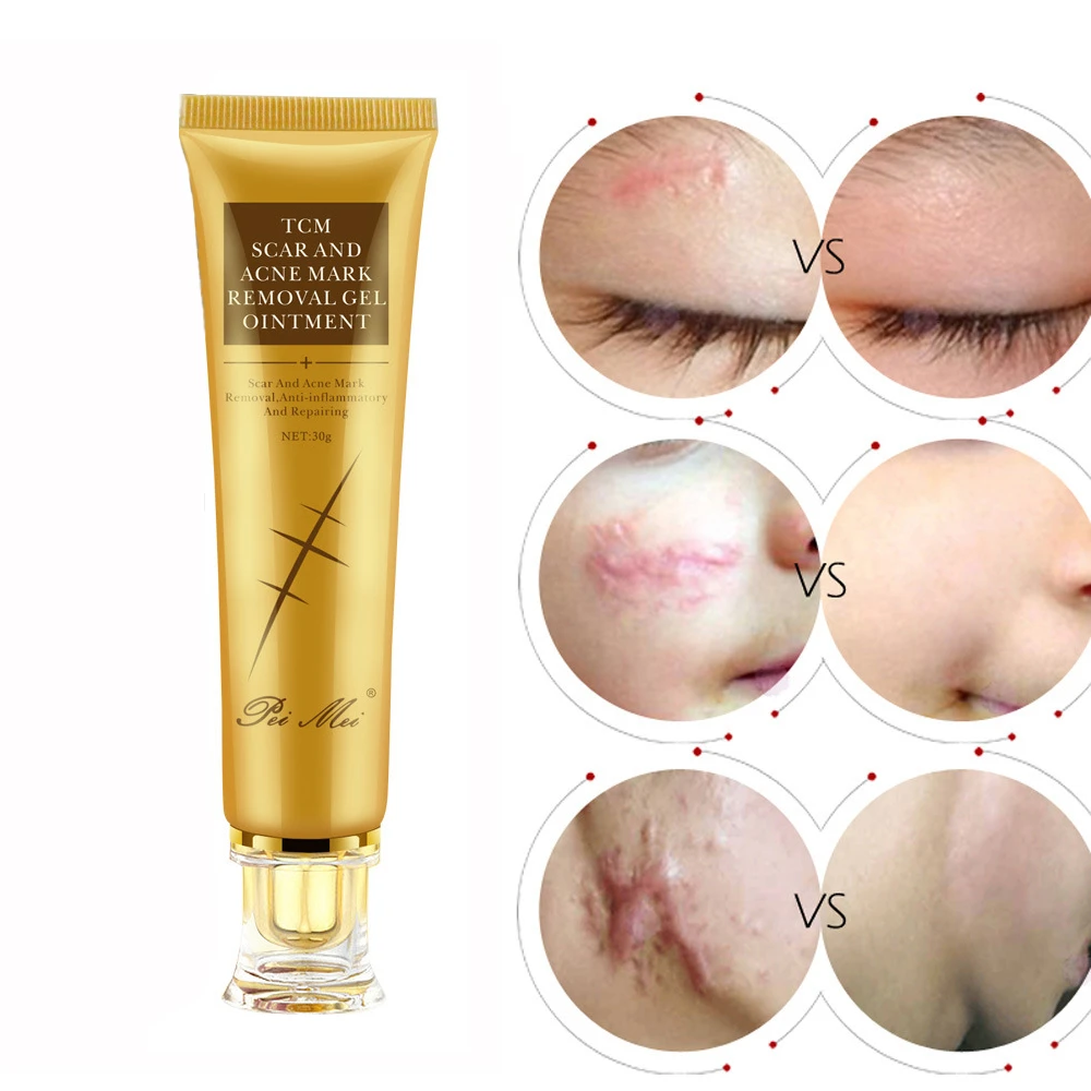 30g Acne Scar Removal Cream Gel Face Pimple Stretch Marks Repairing Cream  Smoothing Whitening Moisturizing Skin Care Body Cream|Creams| - AliExpress