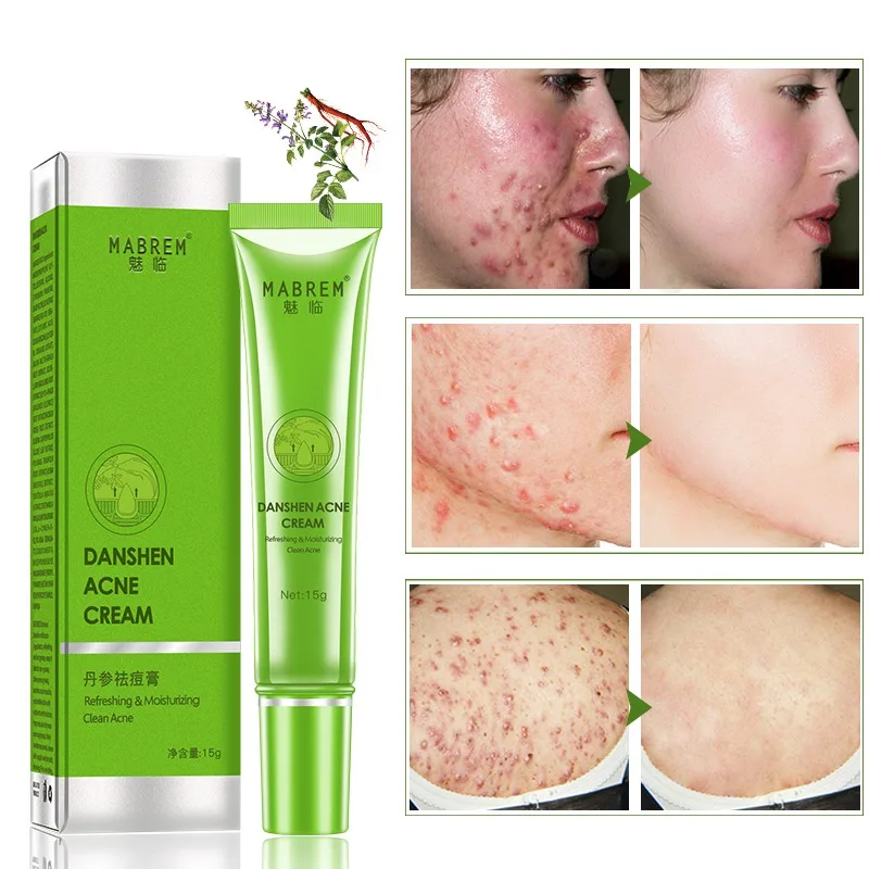 

Tea Tree Anti-Acne Face Cream Oil Control Shrink Pores Acne Scar Remove Skin Care 2019 New