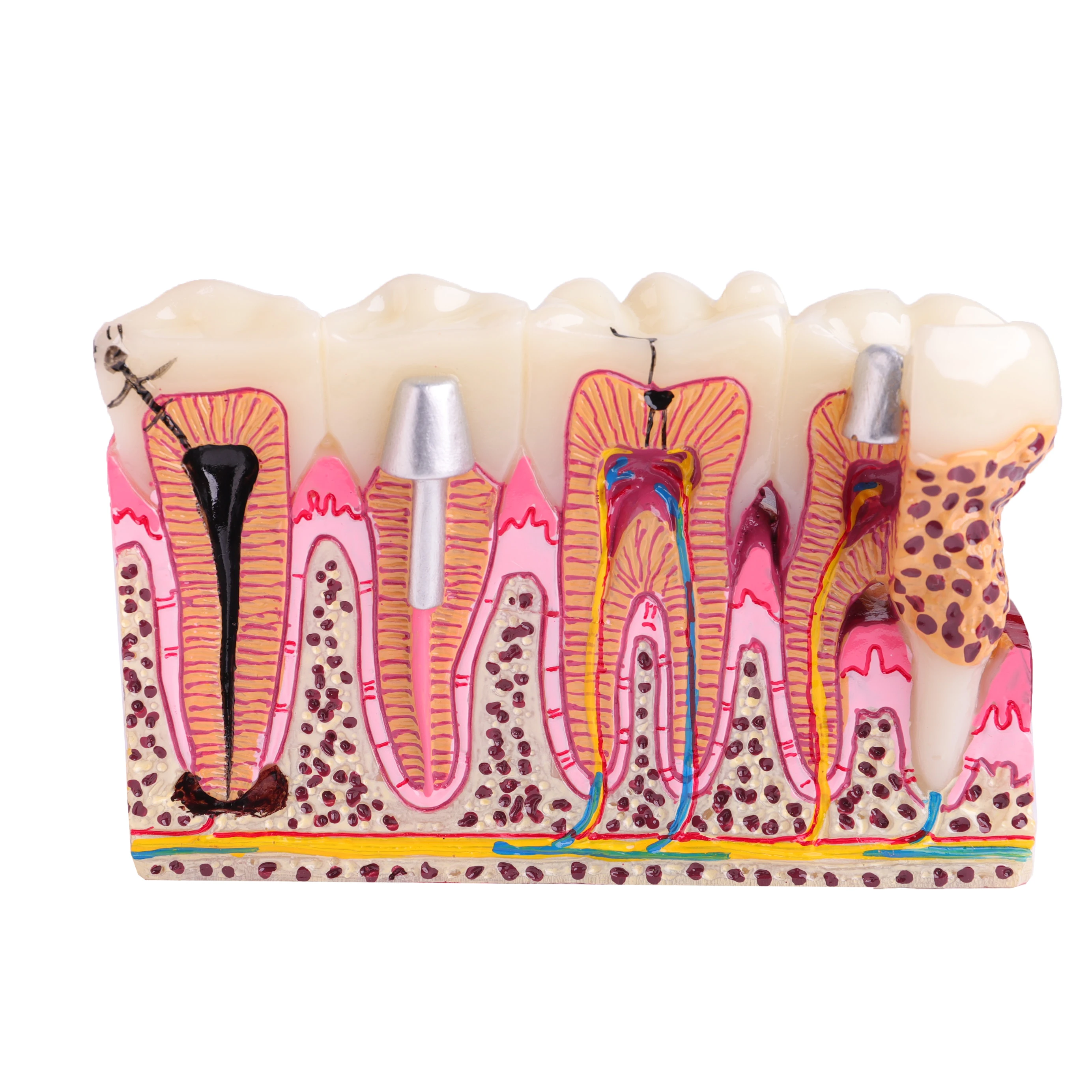 

Dental Anatomy of Dental Caries Teeth Model Demonstration M4029 Planting Pathological Display Model