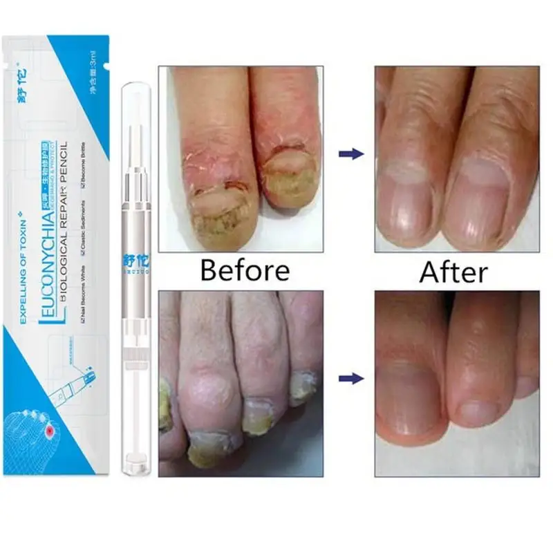 Противогрибковые ручки для лечения Ногтей Onychomycosis Paronychia инфекция травяной носок ногти лечение здоровья Красота аксессуары