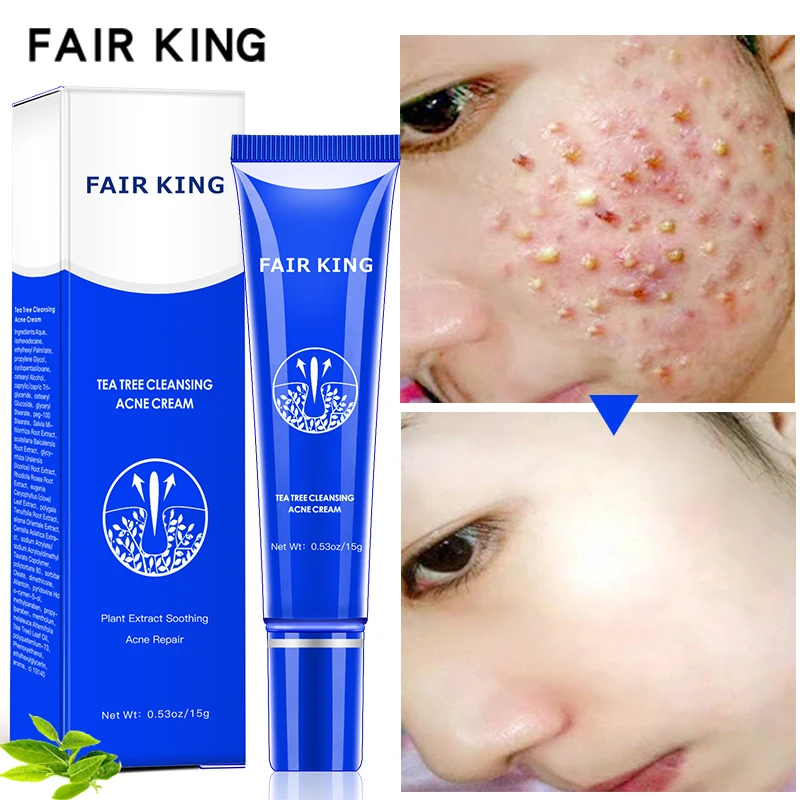 Bleaching Akne Behandlung Mitesser Entfernung Anti Akne Creme 15g Dark Spot Corrector Haut Bleaching Verblassen Creme g Facial Self Tanners Bronzers Aliexpress