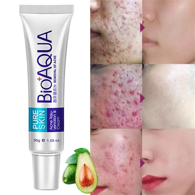 

BIOAQUA Acne Removal Cream Gel Treatment Anti-Acne Scar Whitening Cream Moisturizing Oil Control Acne Remover Skin Care 30g