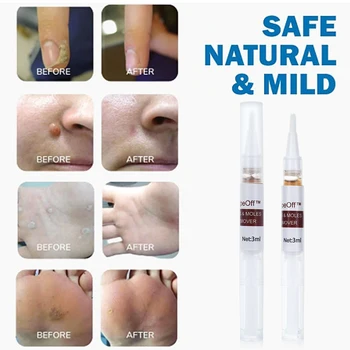 

3ml Liquid Wart Removal Pen WipeOff Tags Moles Remover Genital Wart Treatment Mighty Tag Spots Remover Wart Tag Freckle Skin