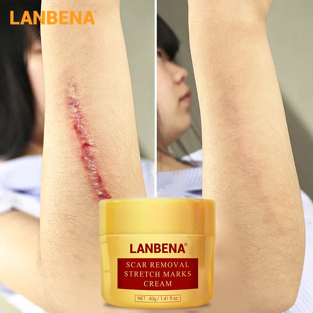 

LANBENA Scar Removal Cream Acne Treatment Repairing Scar Non irritating Whitening Cream Anti Winkles Moisturizing Skin Care 40g