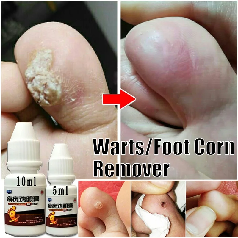 Crema médica para el cuidado de los pies, tratamiento de yeso, verrugas, espina, maíz, callos, desintoxicación, 10ml/5ml