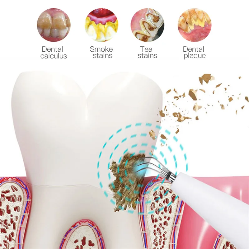 

CkeyiN Teeth Whitening Sonic Vibration Calculus Plaque Stains Remover Tooth Clean Care Oral Hygiene with Mouth Mirror