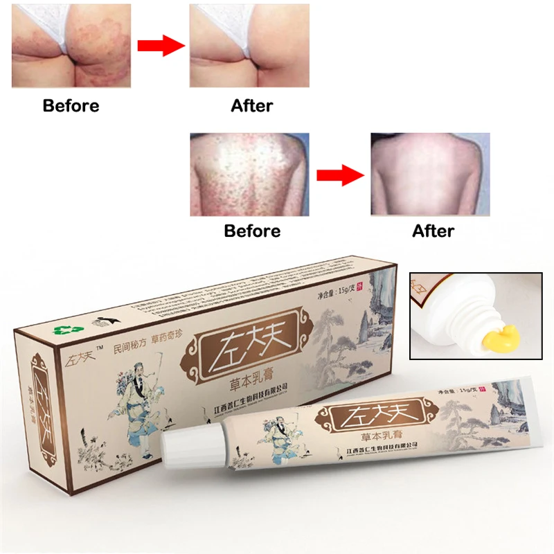 Травяной Антибактериальный крем от псориаза экзема дерматит зуд облегчение боли