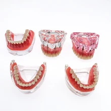 Стоматологическая модель зубов Съемный внутренний Mandibular демо Overdenture с имплантами верхний/нижний для обучения Стоматологическая модель зубов Съемный внутренний Mandibular демо Overdenture с имплантами верхний/нижний для обучения