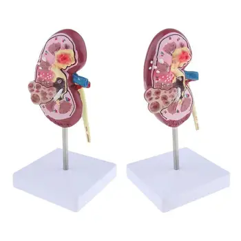 

Anatomical Model Diseased Kidney Model Kidney Model Human Internal Organs Anatomical Model