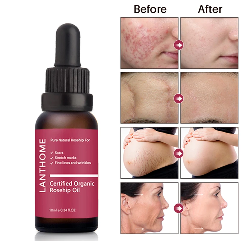 

Lanthome Scar Repair Skin Essential Oil Moisturizing Essence Rosehip Oil Skin Care Natural Pure Remove Ance Treatment Whitening