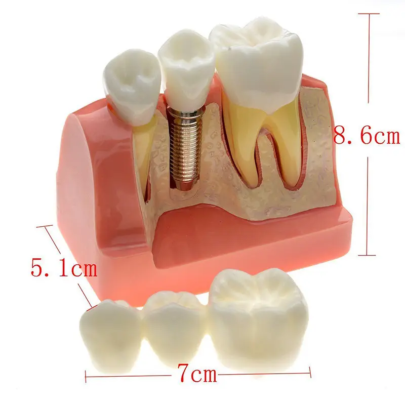 Dental Demonstration Teeth Model Implant Analysis Crown Bridge