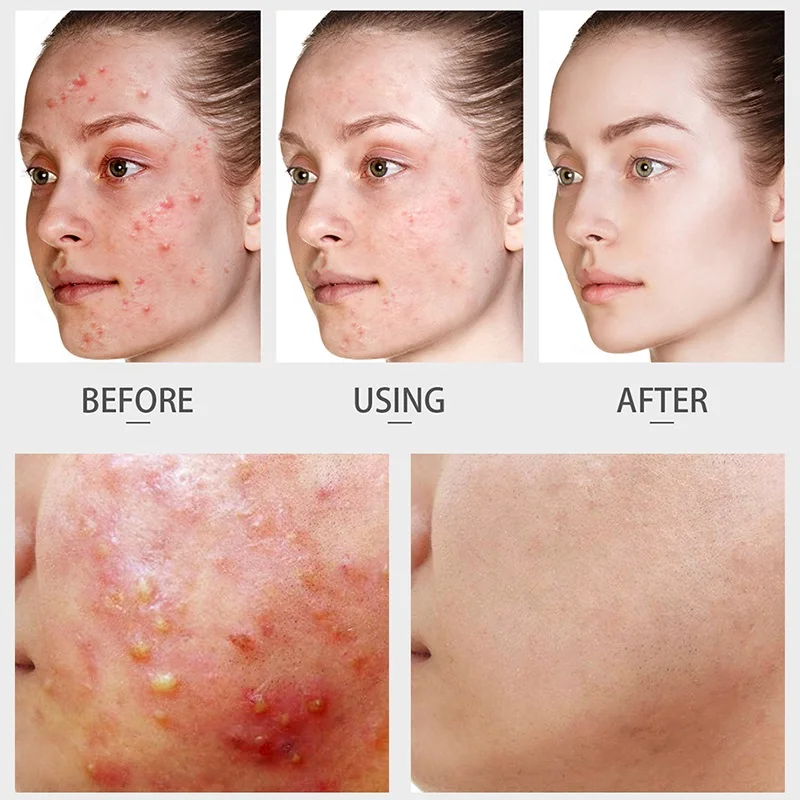 laikou tea tree serum