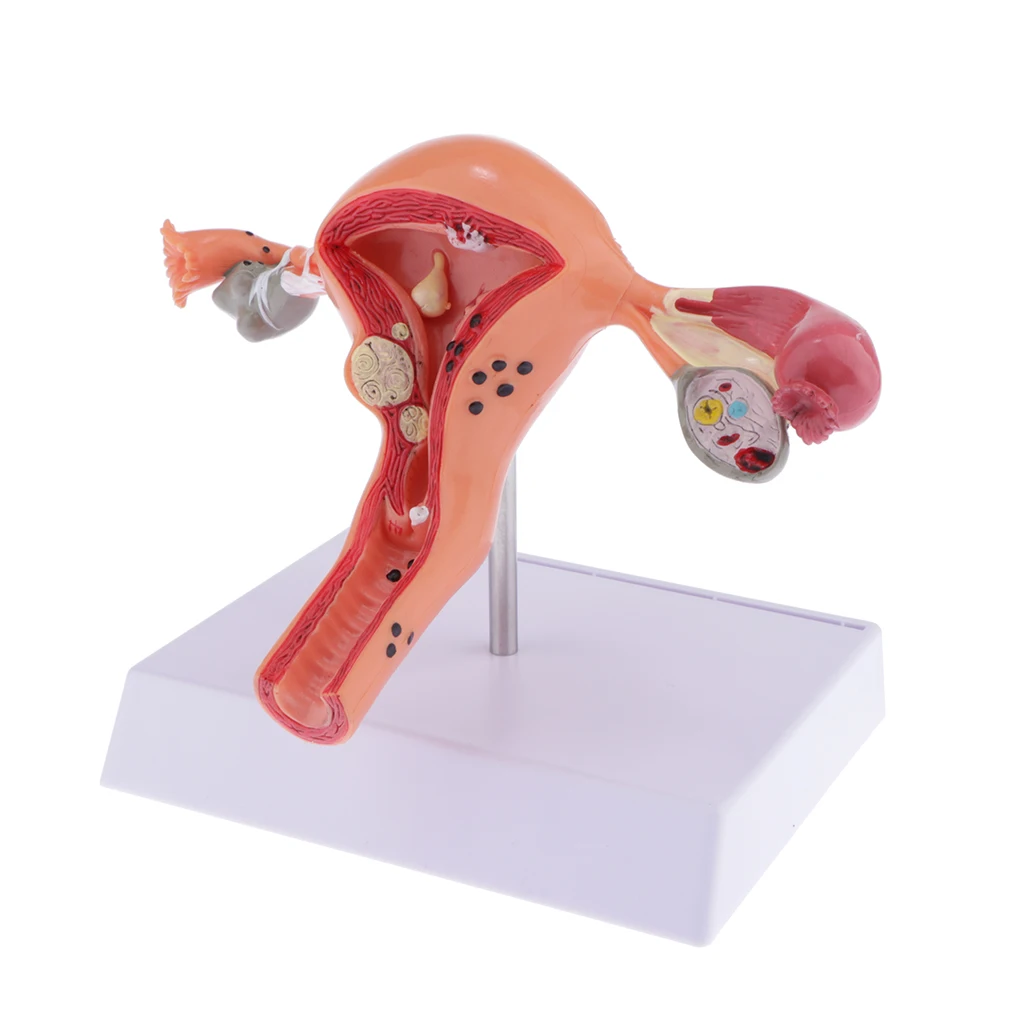 Human Female Uterus Ovary Anatomical Model With Pathologies, 1:1 Life Size, Lab Supplies Decoration