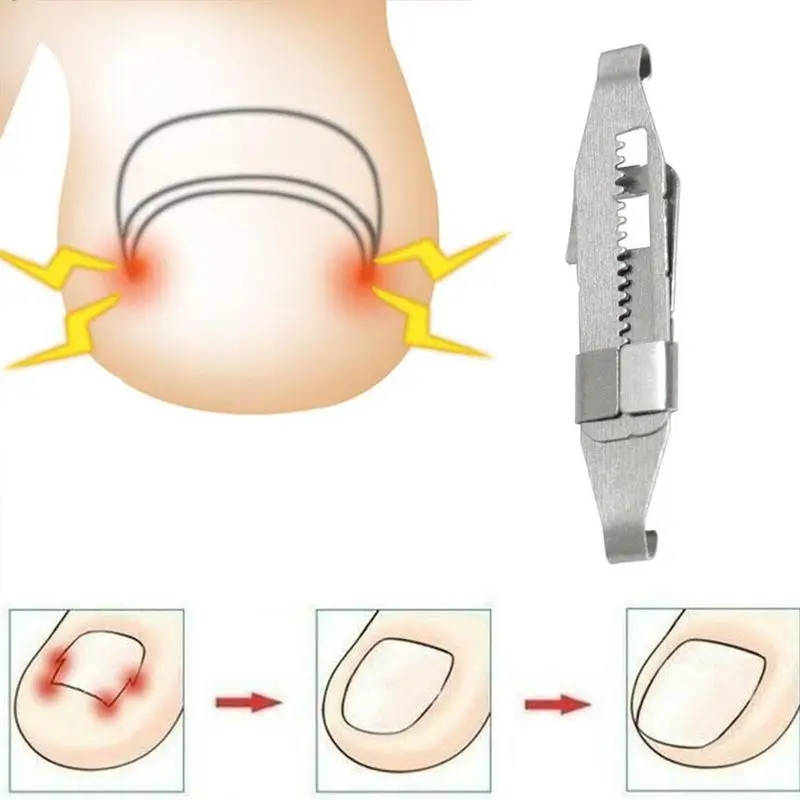 Ingrown Toenail Corrector Toenail Correction Treatment Foot Care Tools Orthotic Nail Fixer Corrector Pedicure Recover Embed Tool Ingrown Toenail Corrector Toenail Correction Treatment Foot Care Tools Orthotic Nail Fixer Corrector Pedicure Recover Embed Tool