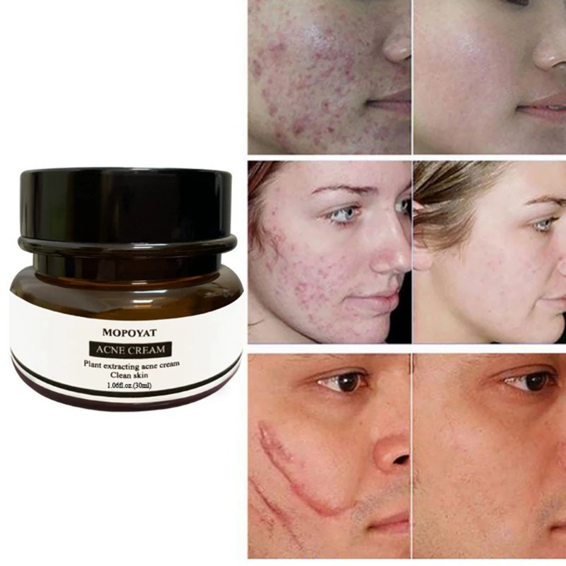 Настоятельно рекомендуем 30g против рубцов от акне Удаление прыщей Blackhead, отбеливает, контроль жирности, сжимает поры, акне лечение