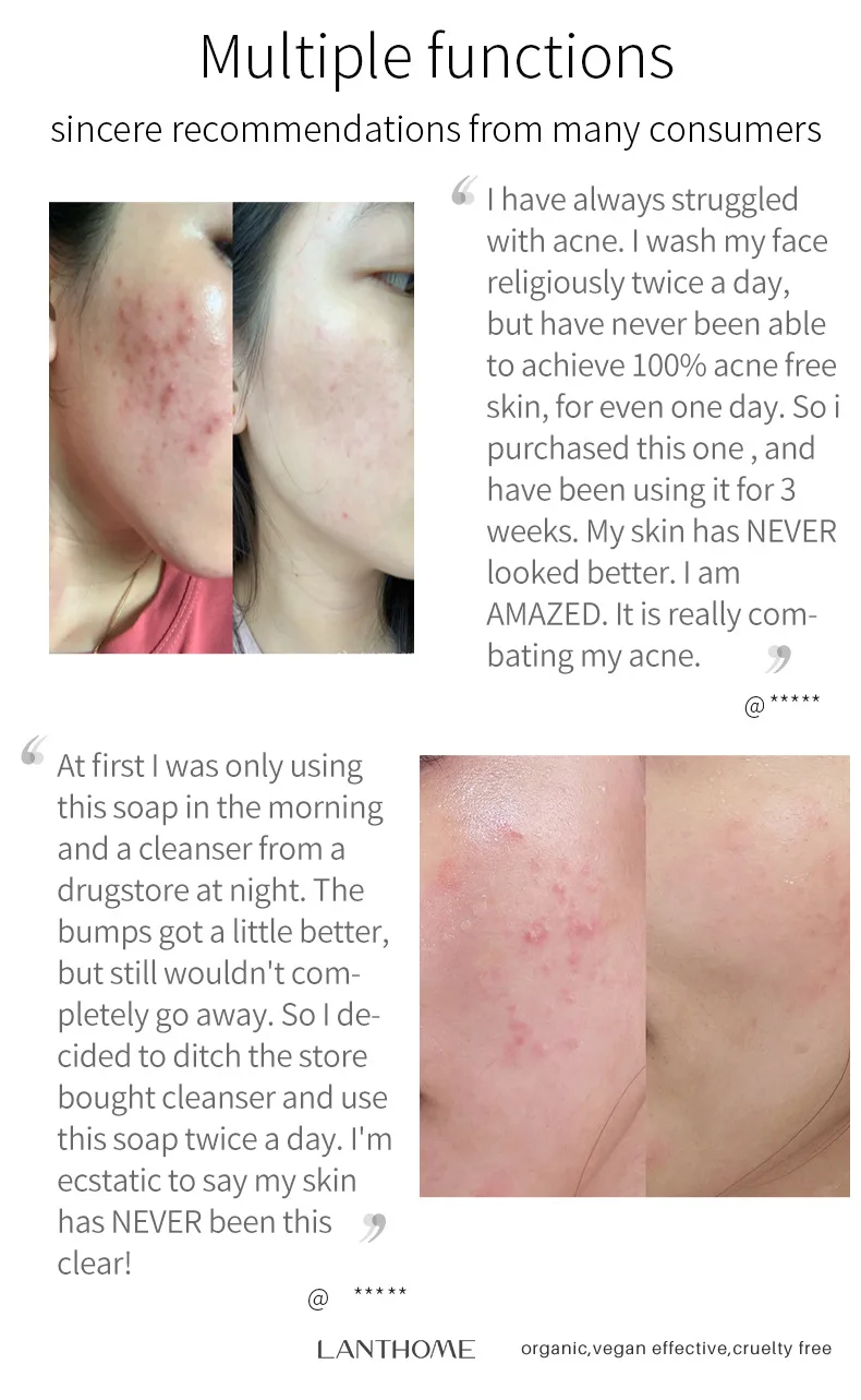 Anti-acne Turmeric Soap Cleans Skin Remove Mites Shrink Pores For Bath Handmade Natural Skin Whitening Soap Anti-inflammatory