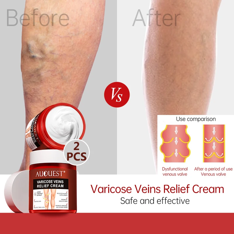 AUQUEST 160g Varicose Veins Relief Cream Vasculitis Phlebitis Spider
