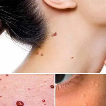 

5ML Skin Tag Remover Warts Treatment Against Mole Wipe Moles Tags Off Remover & T2I6