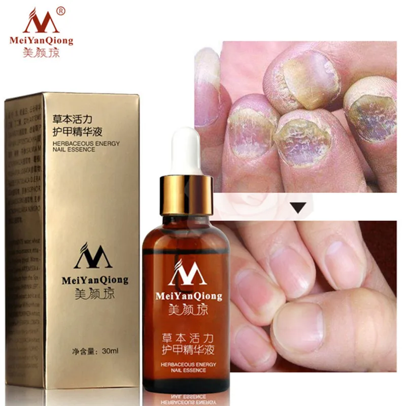 Fungal Nail Treatment Feet Care Essence Nail Foot Whitening Toe Nail Fungus Removal Gel Anti Infection Paronychia Onychomycosis